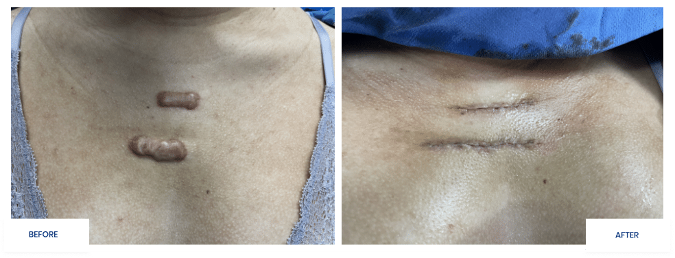 Keloid Removal Specialists in South Florida