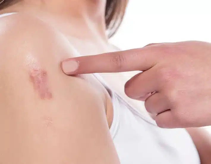 Keloid scar tissue can form in response to a previous injury, such as a cut or burn.