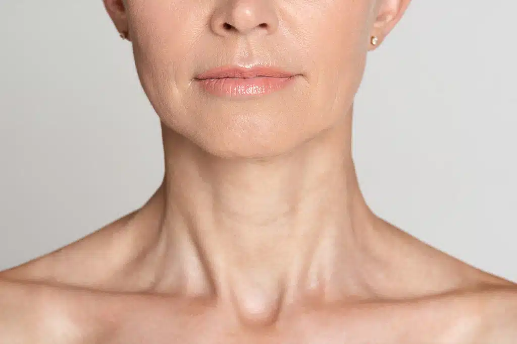 Superficial Radiation Therapy for Keloids