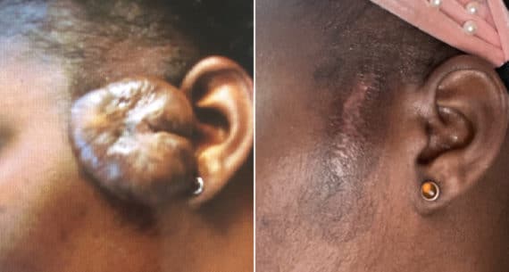 Keloid Removal before and after photos in Miami Beach, FL