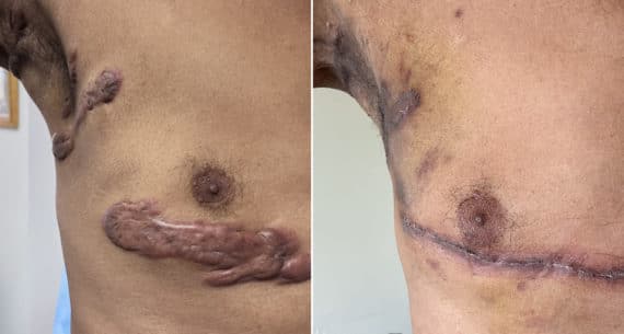 Keloid Removal before and after photos in Miami Beach, FL