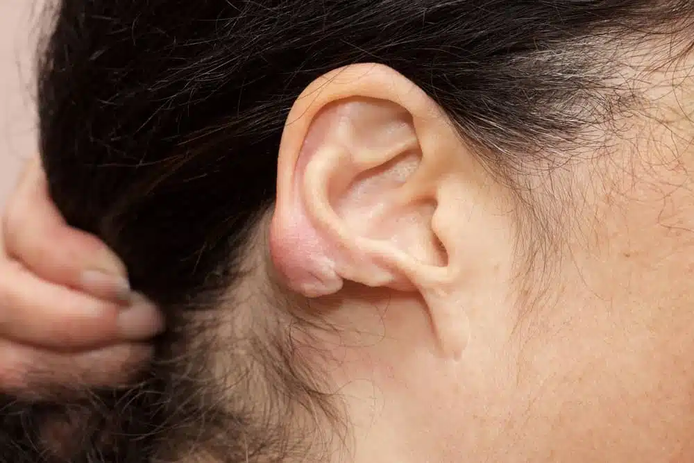 Ear piercings are one of the reasons for keloid appearance. With cryotherapy, you can stop the itching and other keloid symptoms.