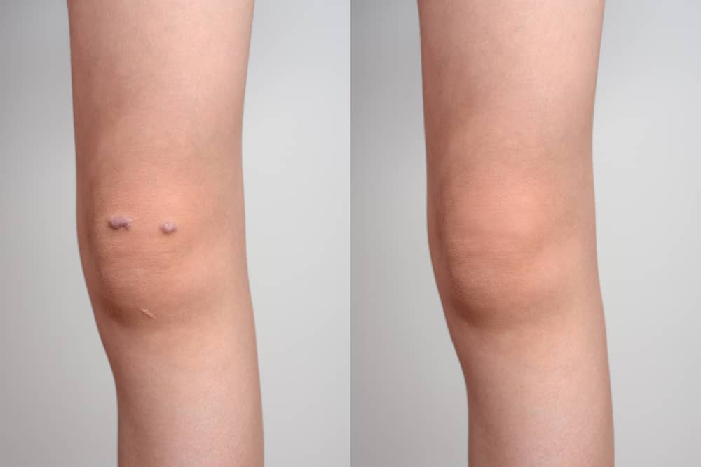 SRT is a non-invasive treatment that doesn't compromise healthy tissue to remove keloids