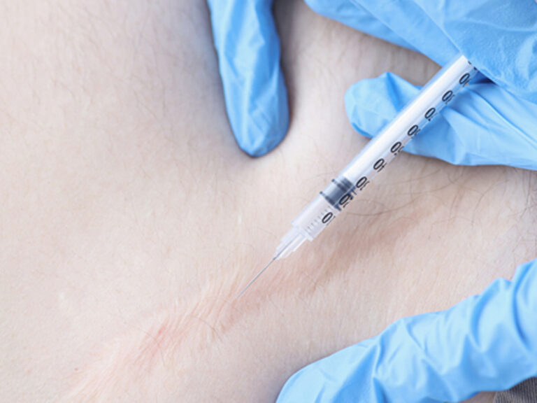 Open Heart Surgery Scar Healing How to care scars Miami, FL