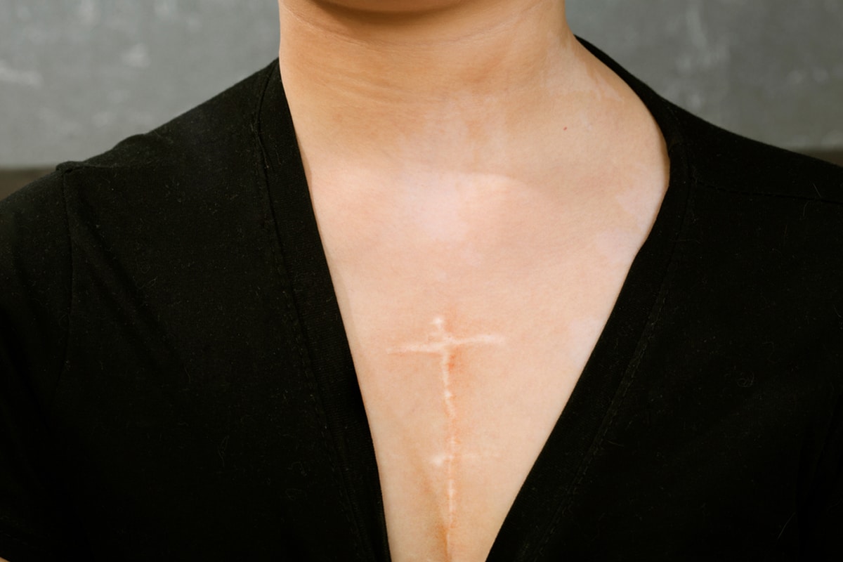 Open Heart Surgery Scar Healing How To Care Scars Miami FL