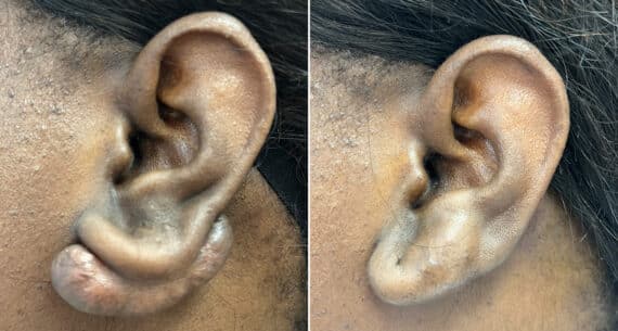 Keloid Removal before and after photos in Aventura, FL