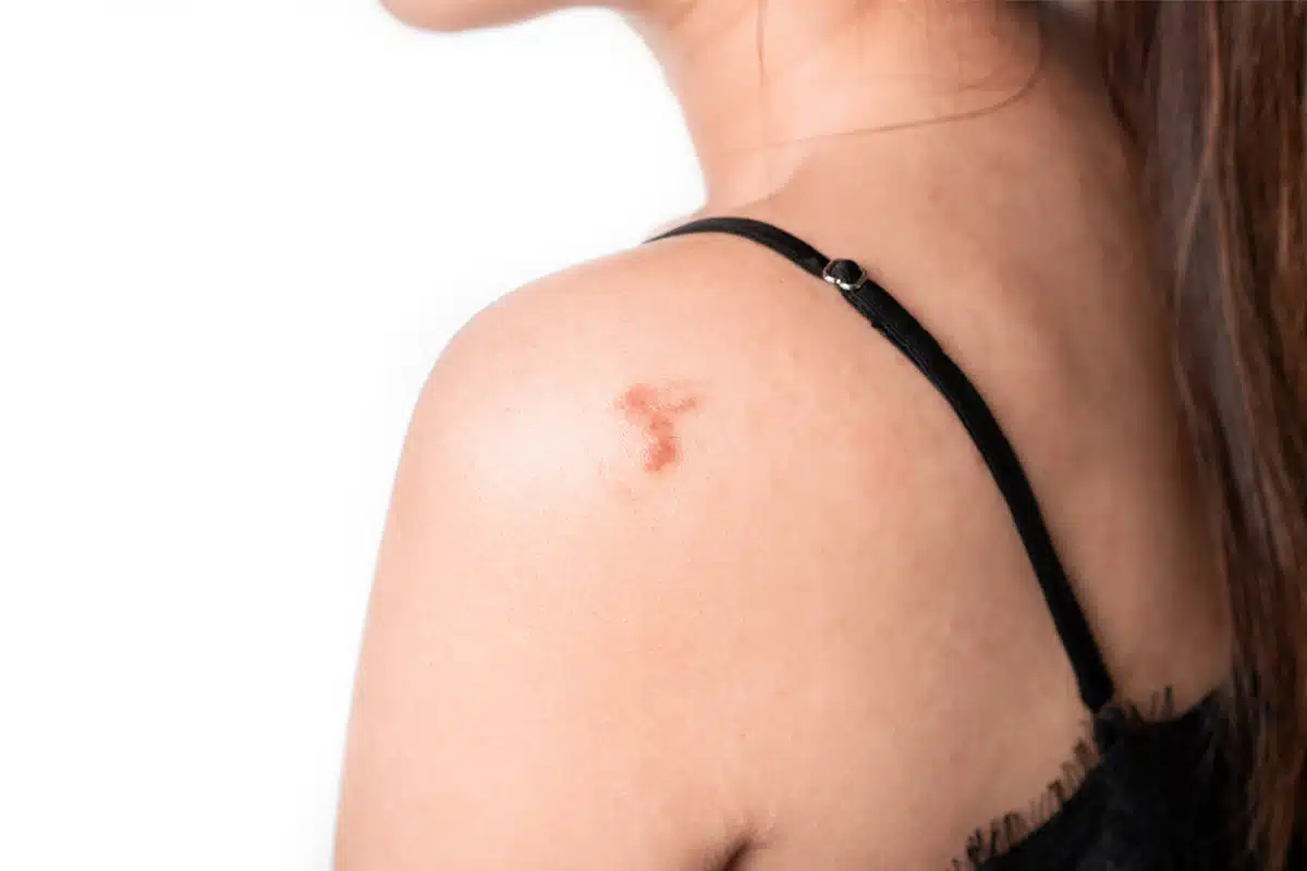 Keloid removal surgery is a surgical procedure used to remove abnormal scar tissue