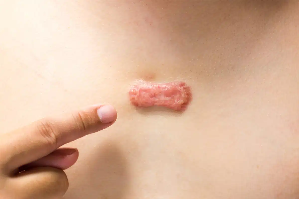 Our team of keloid experts at Miami Beach specializes in treating chest keloids and providing comprehensive solutions.