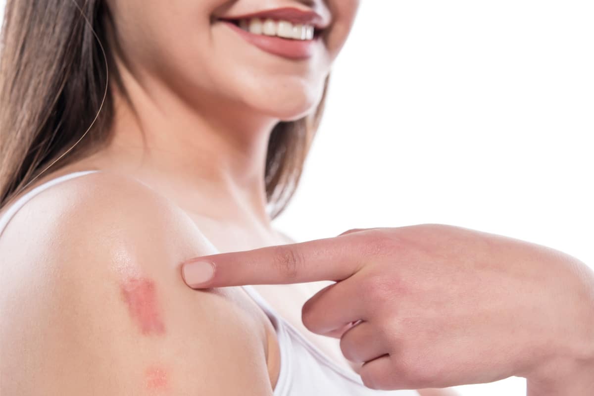 Innovative Techniques in Keloid Removal