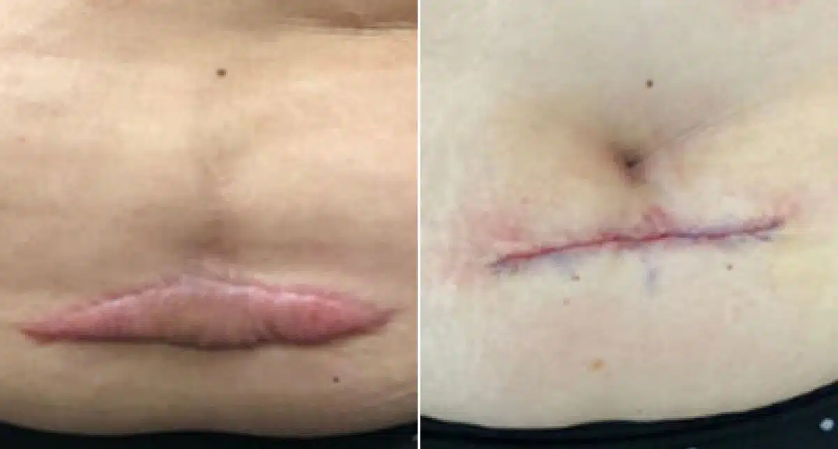 Keloid Removal before and after photos in Aventura, FL, Patient 2332