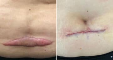 Keloid Removal before and after photos in Aventura, FL, Patient 2332