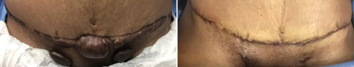 Keloid Removal before and after photos in Aventura, FL, Patient 2340