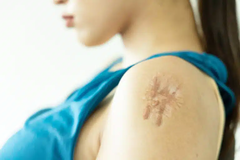 Keloid Scar Removal Pricing Guide Expenses Breakdown