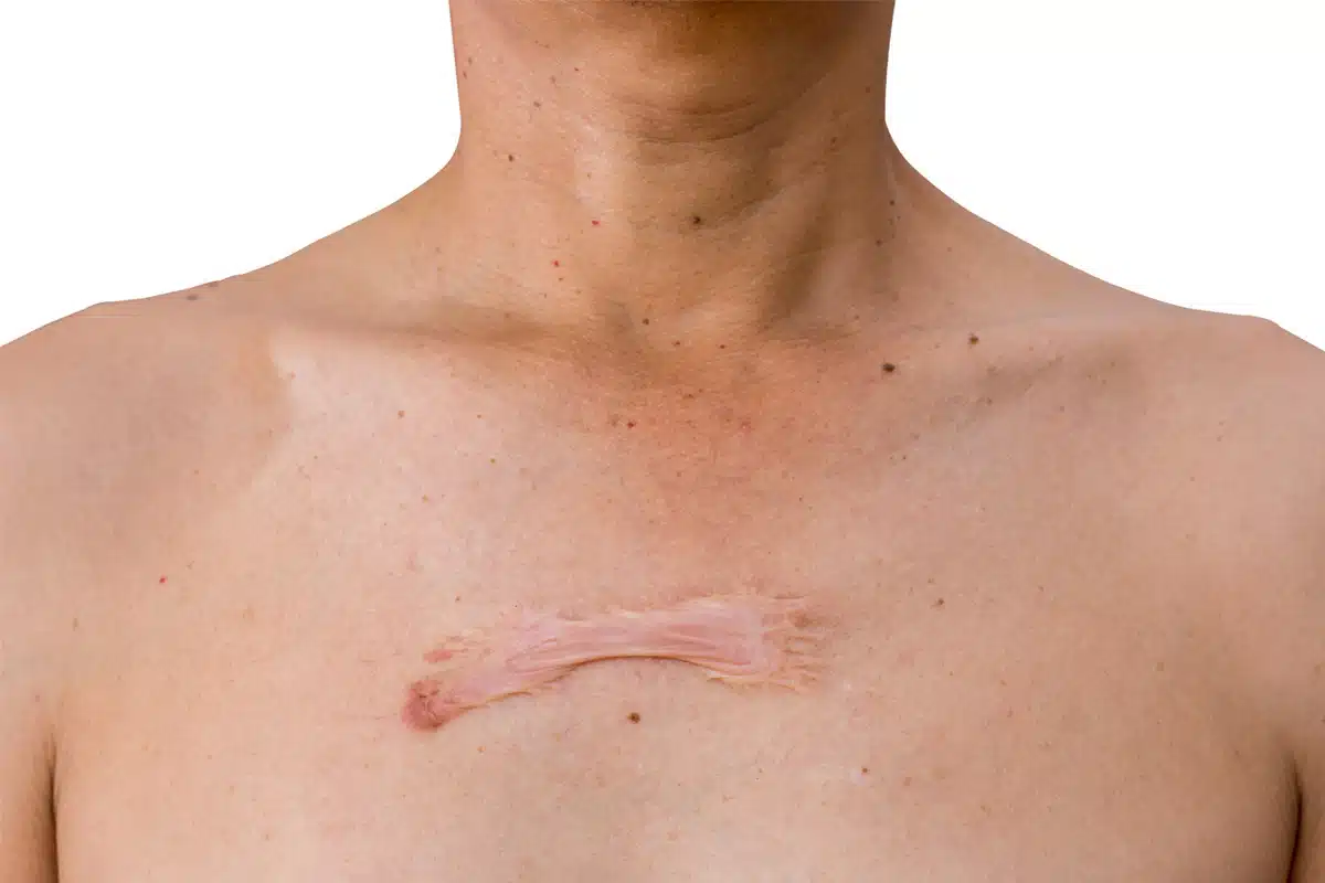 Effective Strategies for Chest Keloid Removal