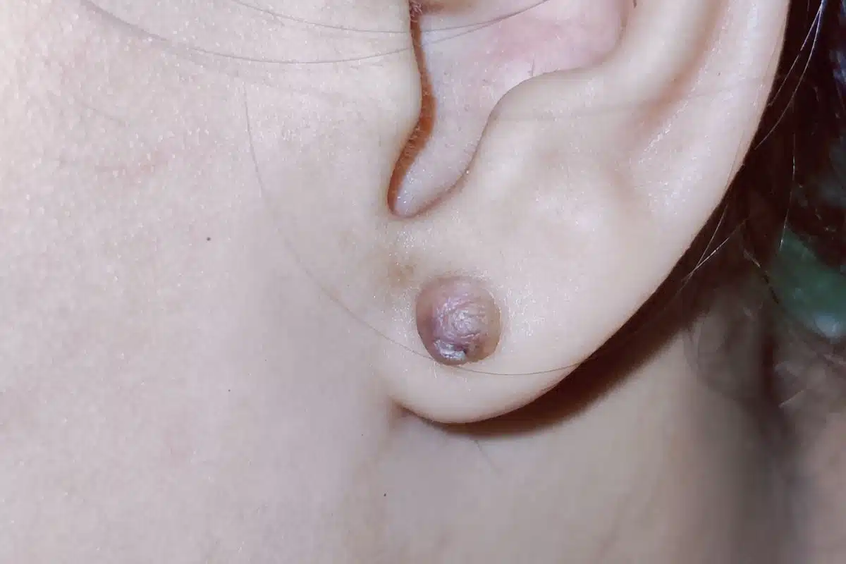 Close-up of earlobe showing a soft, small piercing bump with mild redness and swelling after recent piercing.