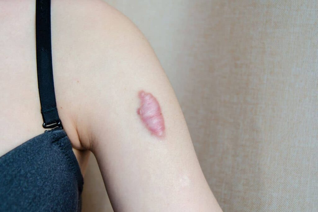Close-up of a raised keloid scar on the upper arm, showing a common candidate for cryotherapy treatment.