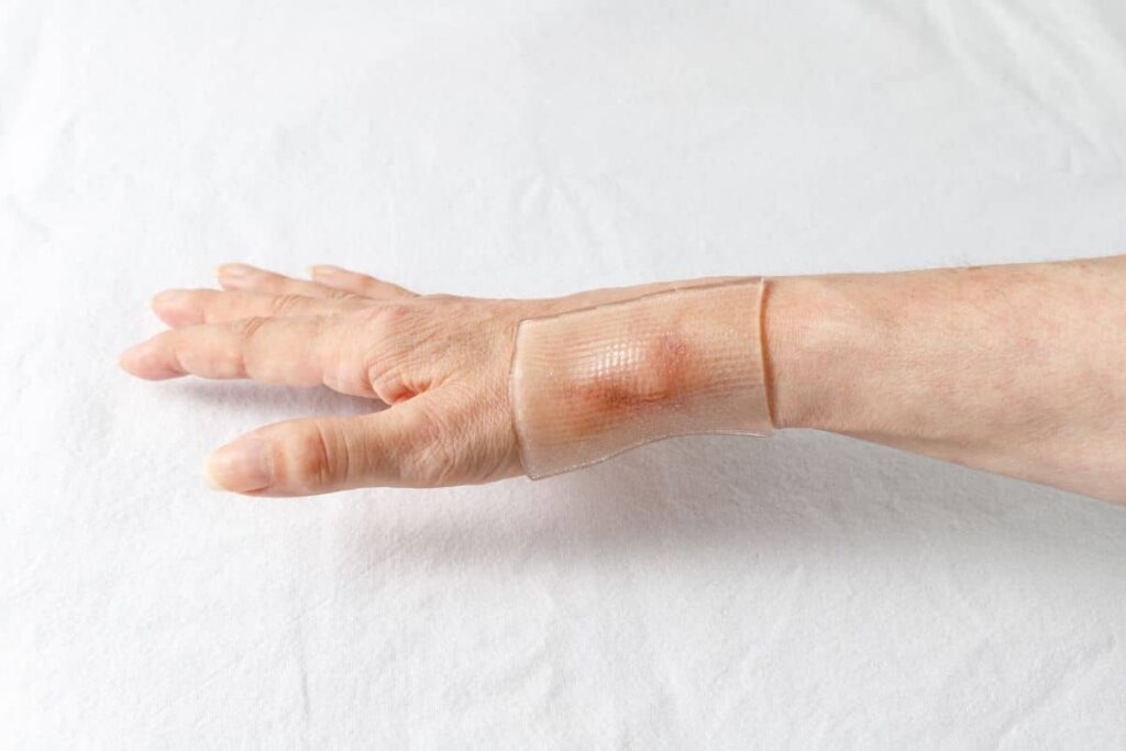 Hand with a raised keloid scar covered by silicone sheeting, demonstrating a non-invasive treatment option.