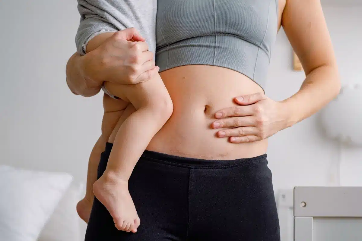 Woman holding baby showing C-section scar area with possible keloid development after childbirth.
