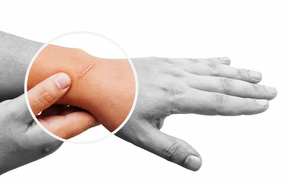 Close-up of hand showing a raised scar highlighted in a circle to compare keloid and hypertrophic scar differences.