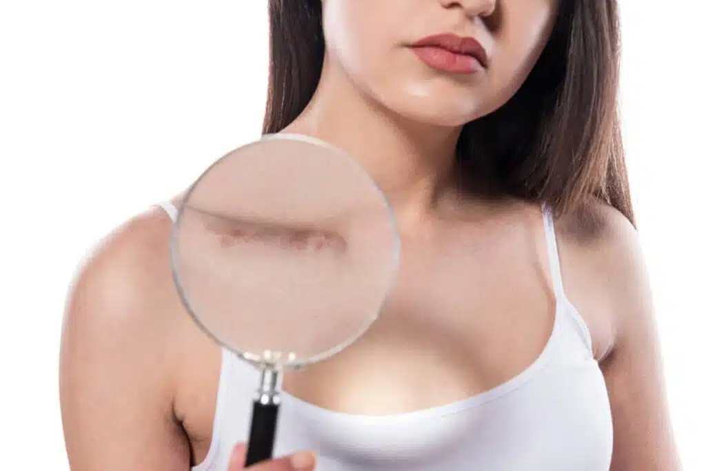 A woman holding a magnifying glass over a surgical scar on her chest, meticulously checking for signs of recurrence or redness during her keloid removal surgery aftercare.