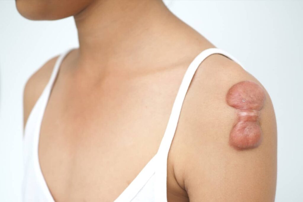 A teenager seen from the side with a large, bulbous, butterfly-shaped keloid scar on their shoulder, demonstrating how adolescent skin can react to trauma.