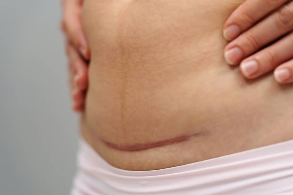 A detailed view of a raised, reddish hypertrophic or keloid scar on a woman's lower abdomen following a surgical birth.