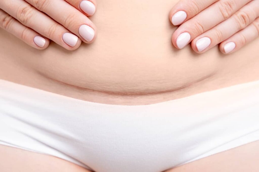 A woman gently placing her hands over a well-healed, faint C-section scar on her lower abdomen, showcasing successful long-term scar management.