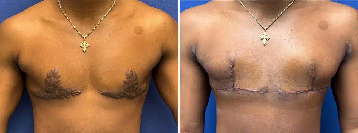 Keloid Removal before and after photos in Aventura, FL, Patient 4531