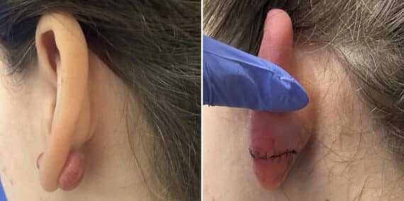 Keloid Removal before and after photos in Aventura, FL, Patient 4537