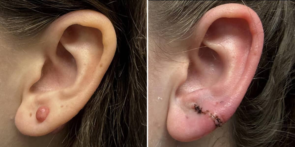 Keloid Removal before and after photos in Aventura, FL, Patient 4537