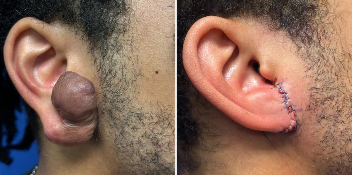 Keloid Removal before and after photos in Aventura, FL, Patient 4540