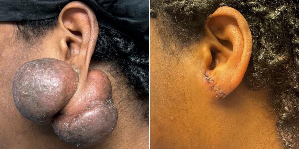 Keloid Removal before and after photos in Aventura, FL, Patient 4540