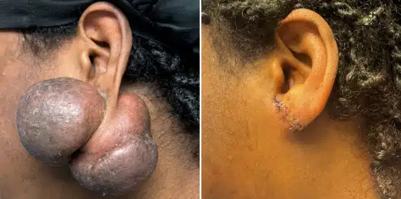 Keloid Removal before and after photos in Aventura, FL, Patient 4540